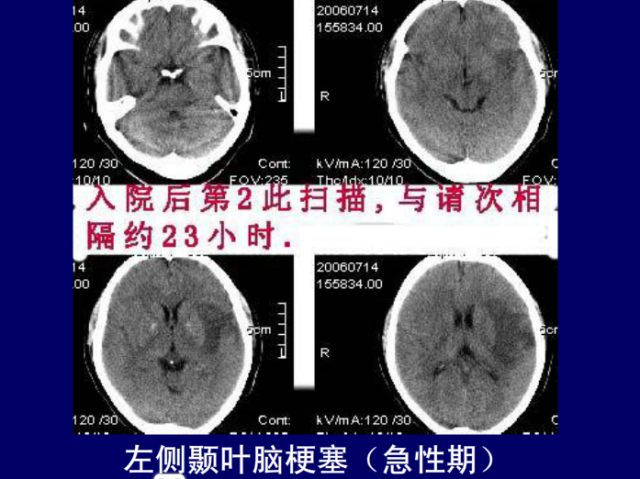 脑血管的影像解剖