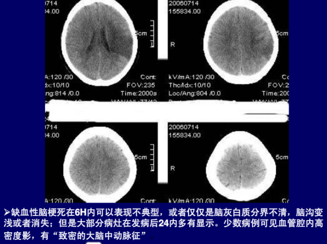脑血管的影像解剖