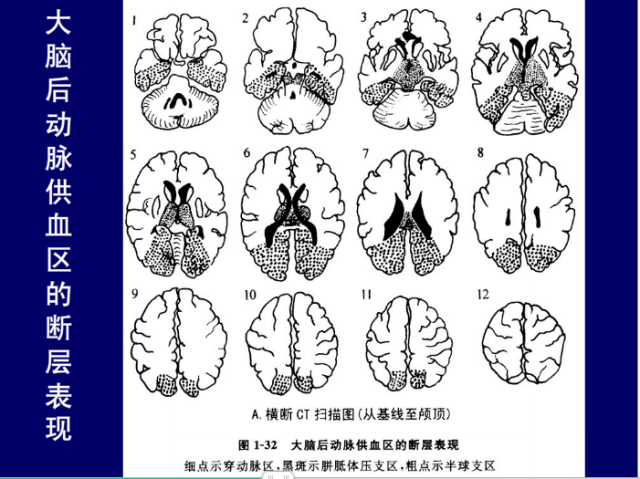 脑血管的影像解剖