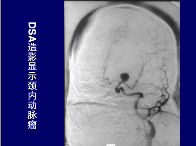 脑血管的影像解剖