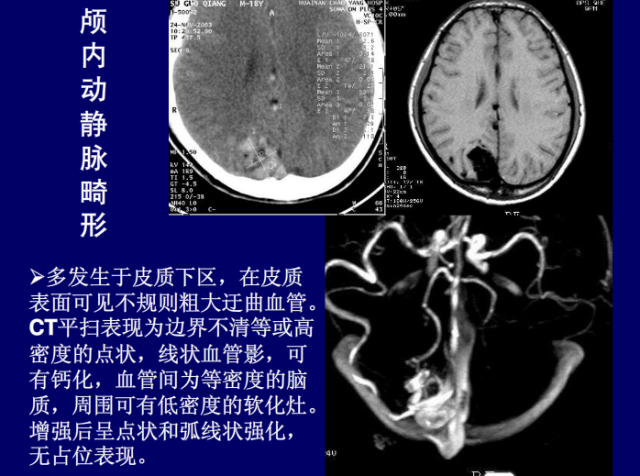 脑血管的影像解剖