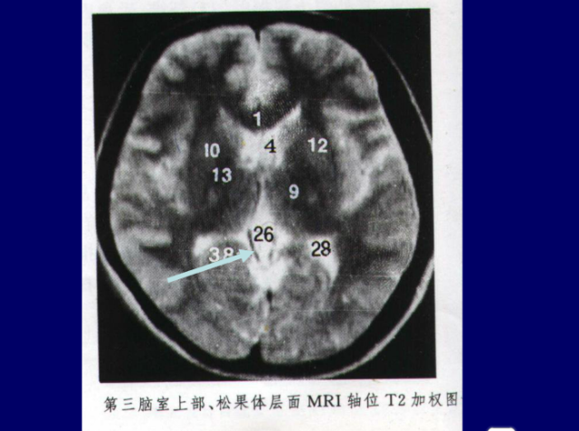 脑血管的影像解剖