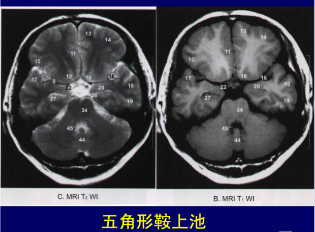 脑血管的影像解剖