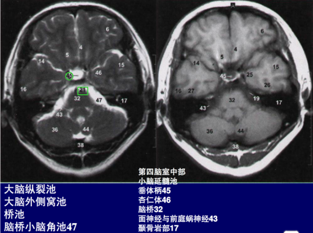 脑血管的影像解剖