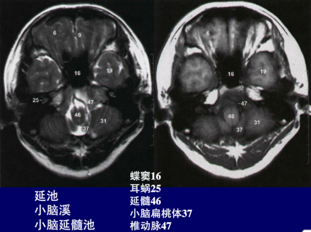 脑血管的影像解剖