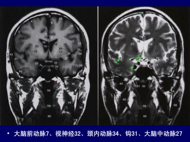 脑血管的影像解剖