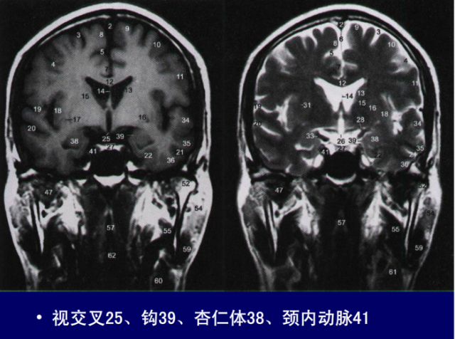 脑血管的影像解剖