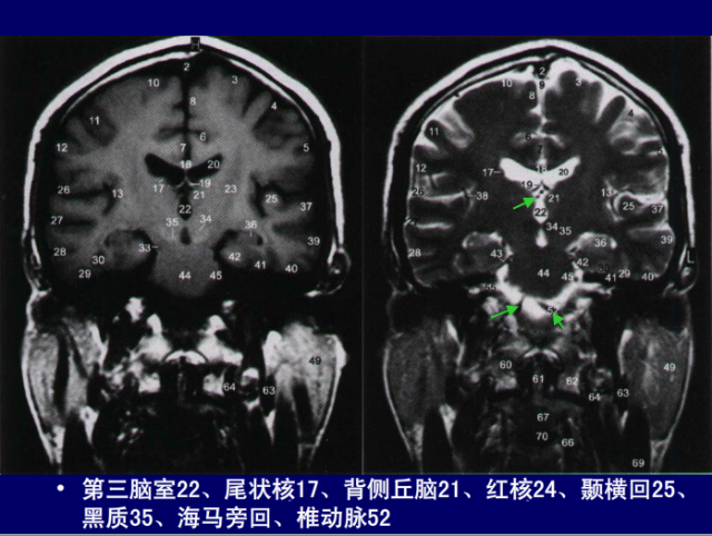 脑血管的影像解剖