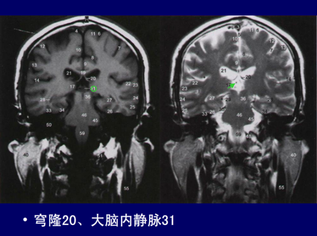 脑血管的影像解剖