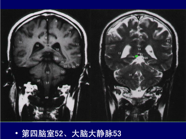 脑血管的影像解剖