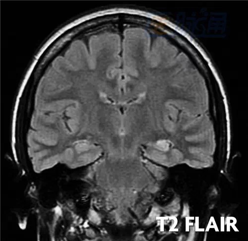 【病例】颞叶内侧硬化一例MR影像分析