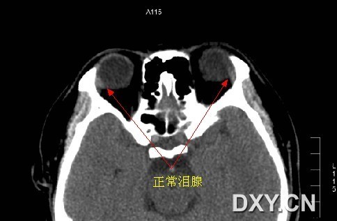 泪腺脱垂的影像诊断