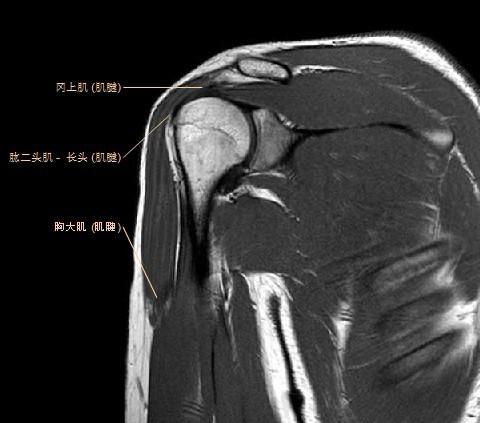 肩关节MRI解剖图谱