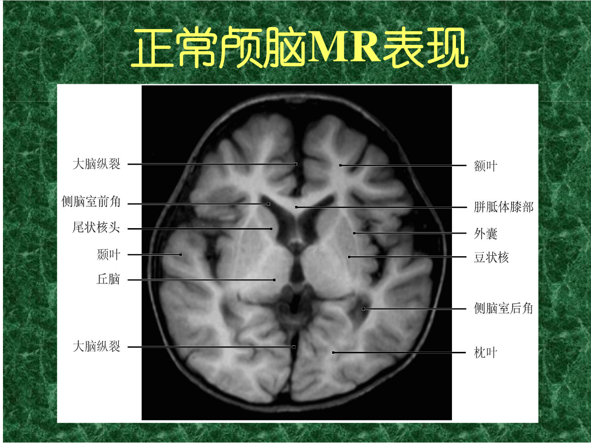 MRI成像在中枢神经系统的应用
