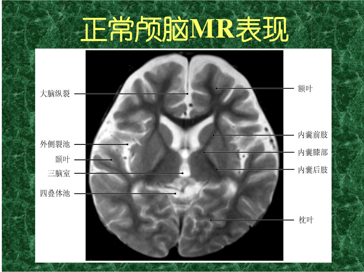 MRI成像在中枢神经系统的应用