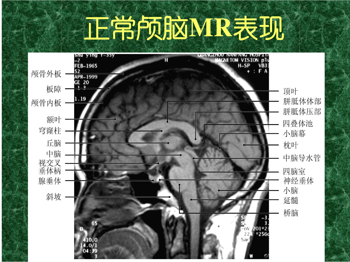MRI成像在中枢神经系统的应用