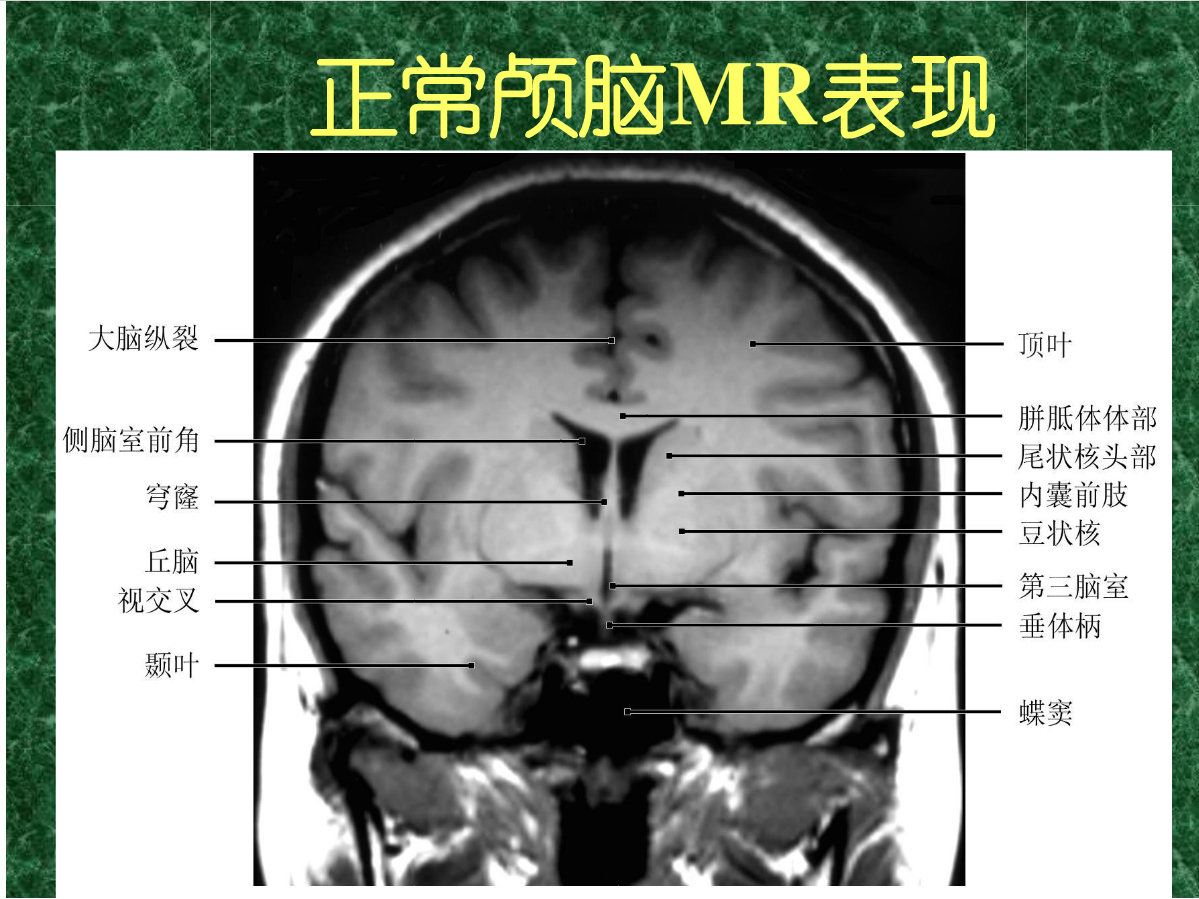 MRI成像在中枢神经系统的应用