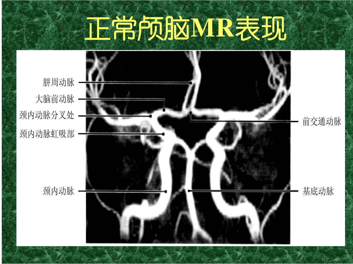 MRI成像在中枢神经系统的应用