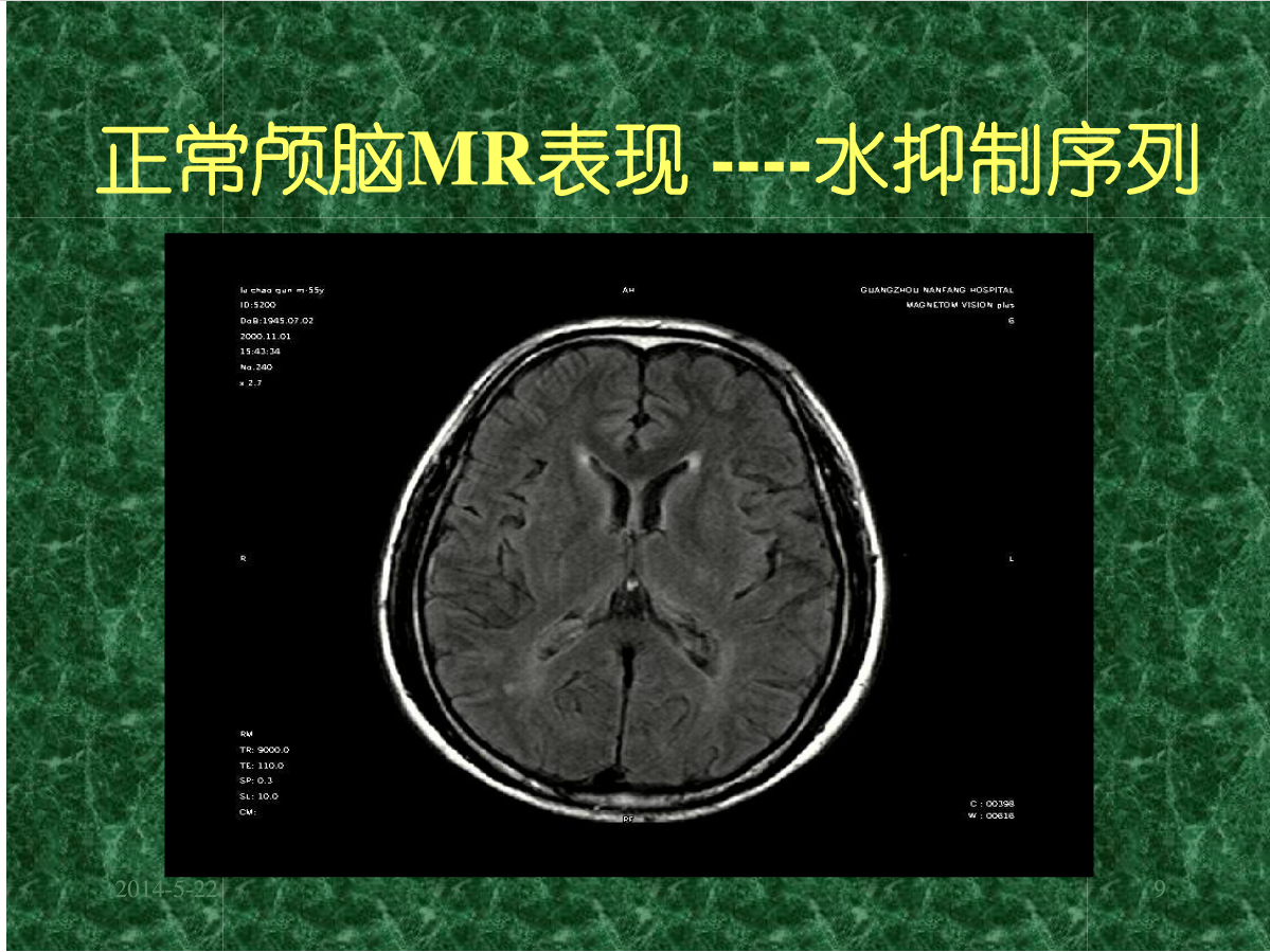 MRI成像在中枢神经系统的应用