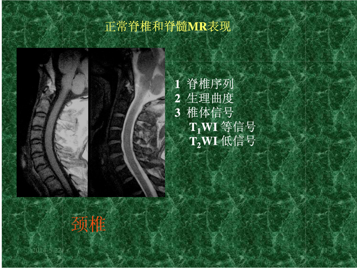 MRI成像在中枢神经系统的应用