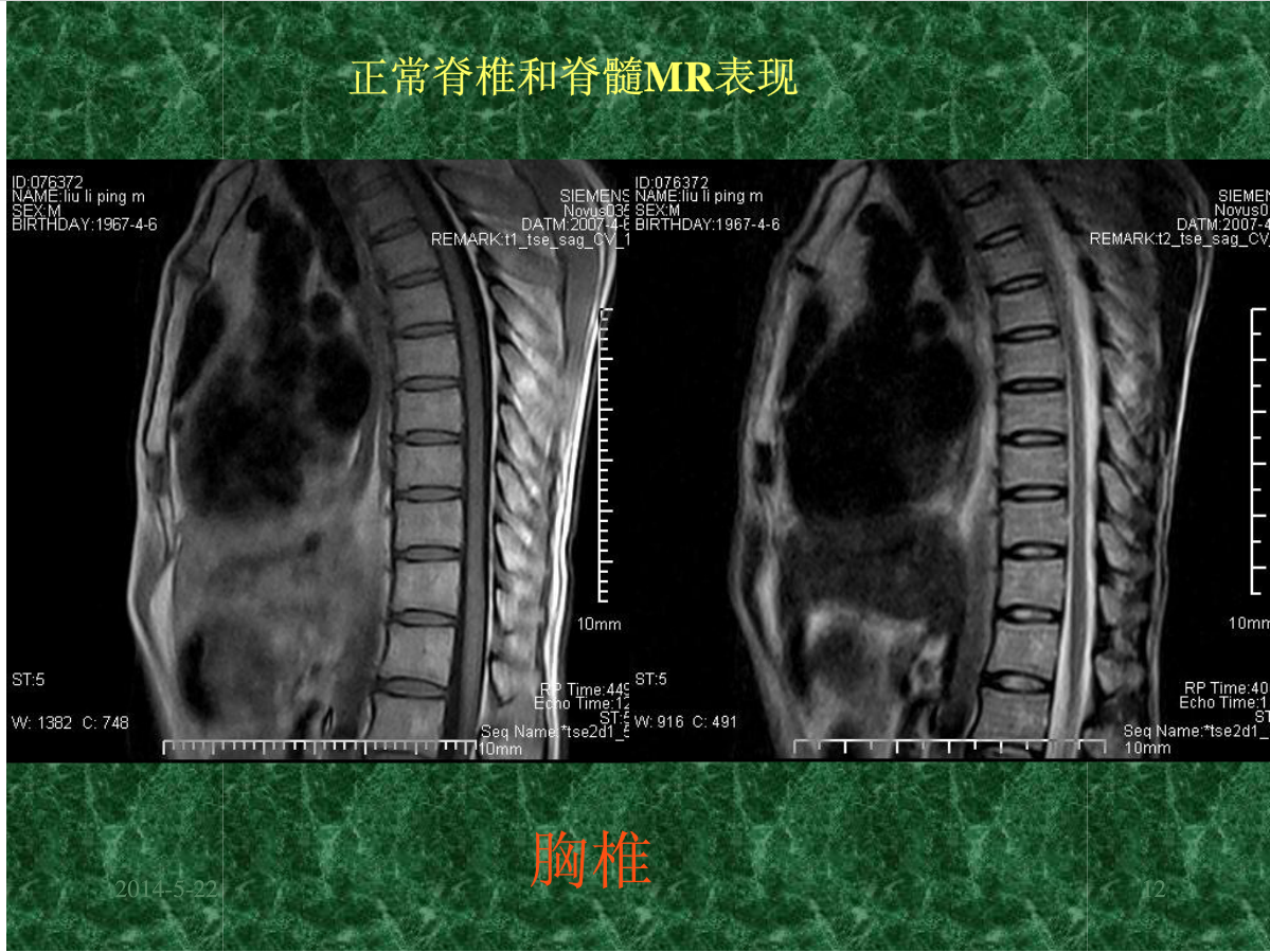 MRI成像在中枢神经系统的应用