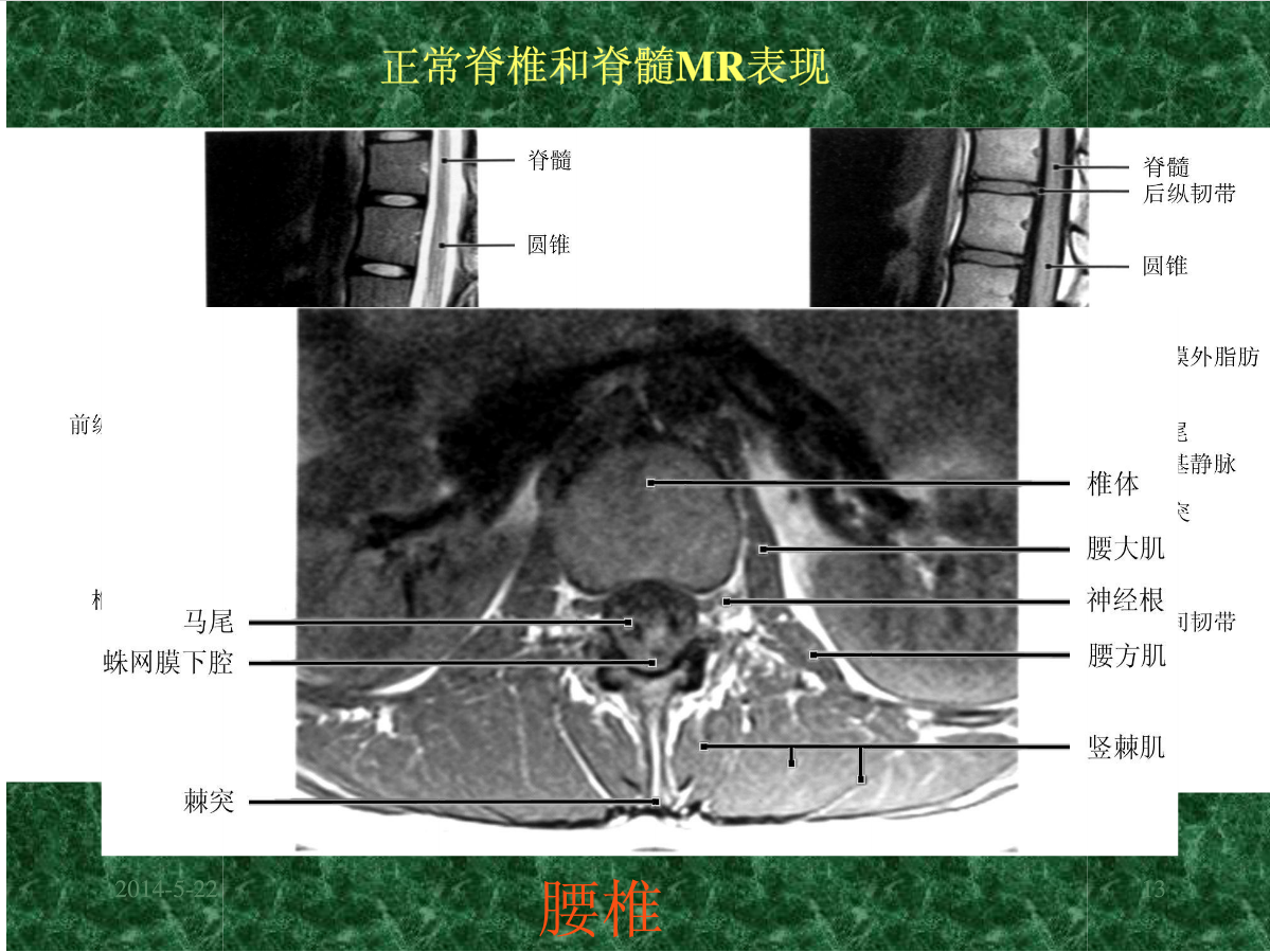 MRI成像在中枢神经系统的应用