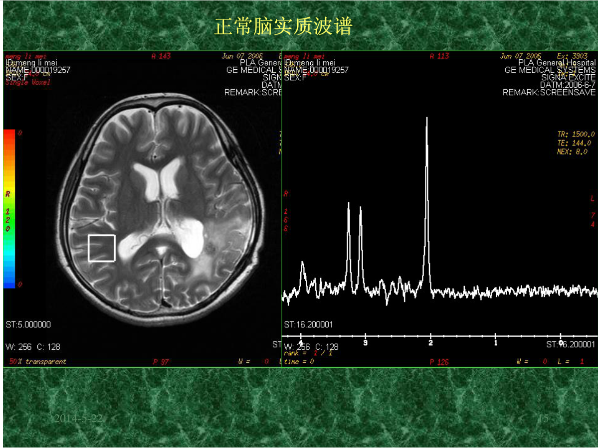 MRI成像在中枢神经系统的应用