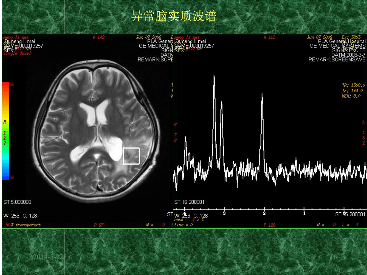 MRI成像在中枢神经系统的应用