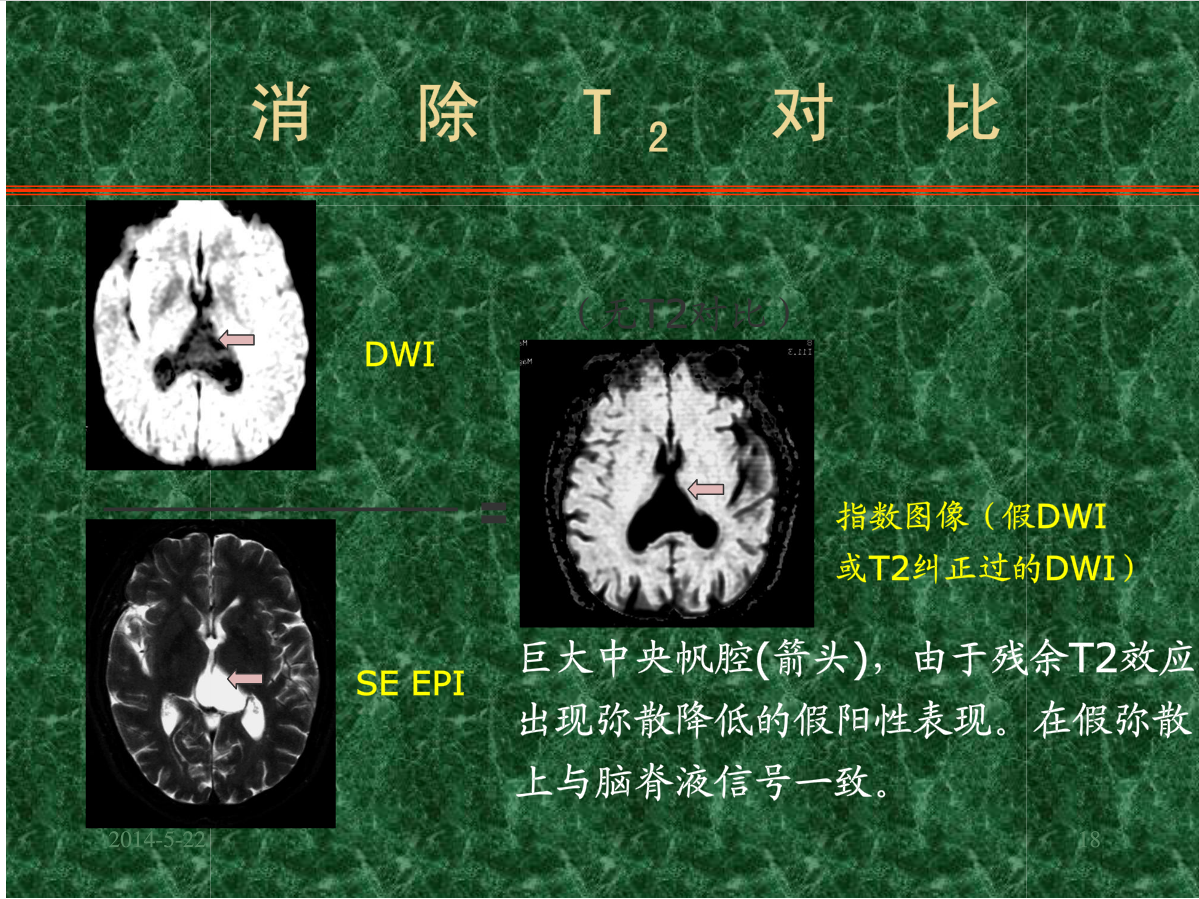 MRI成像在中枢神经系统的应用