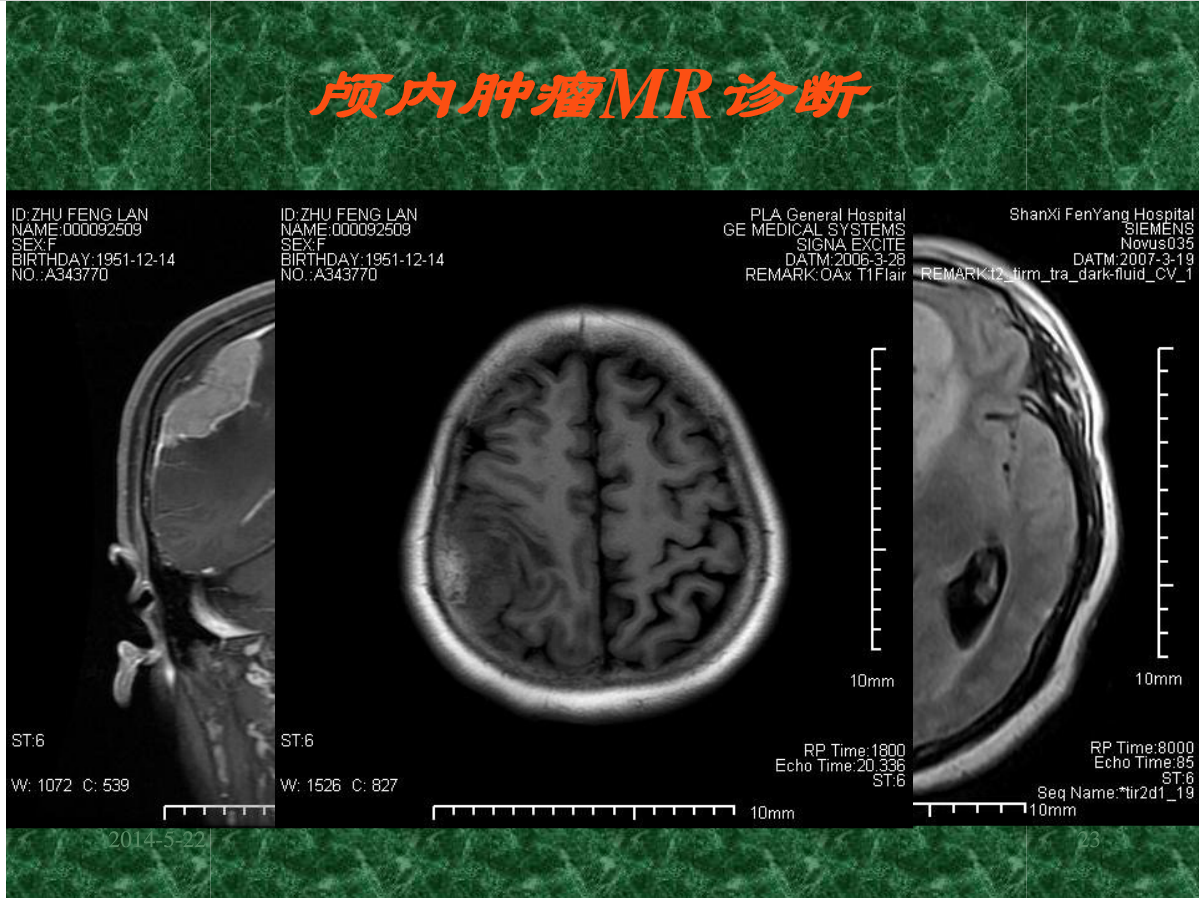 MRI成像在中枢神经系统的应用