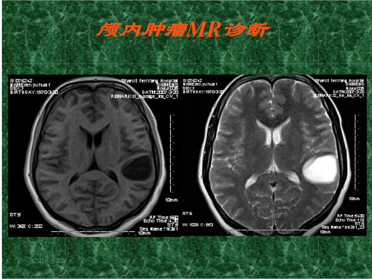 MRI成像在中枢神经系统的应用