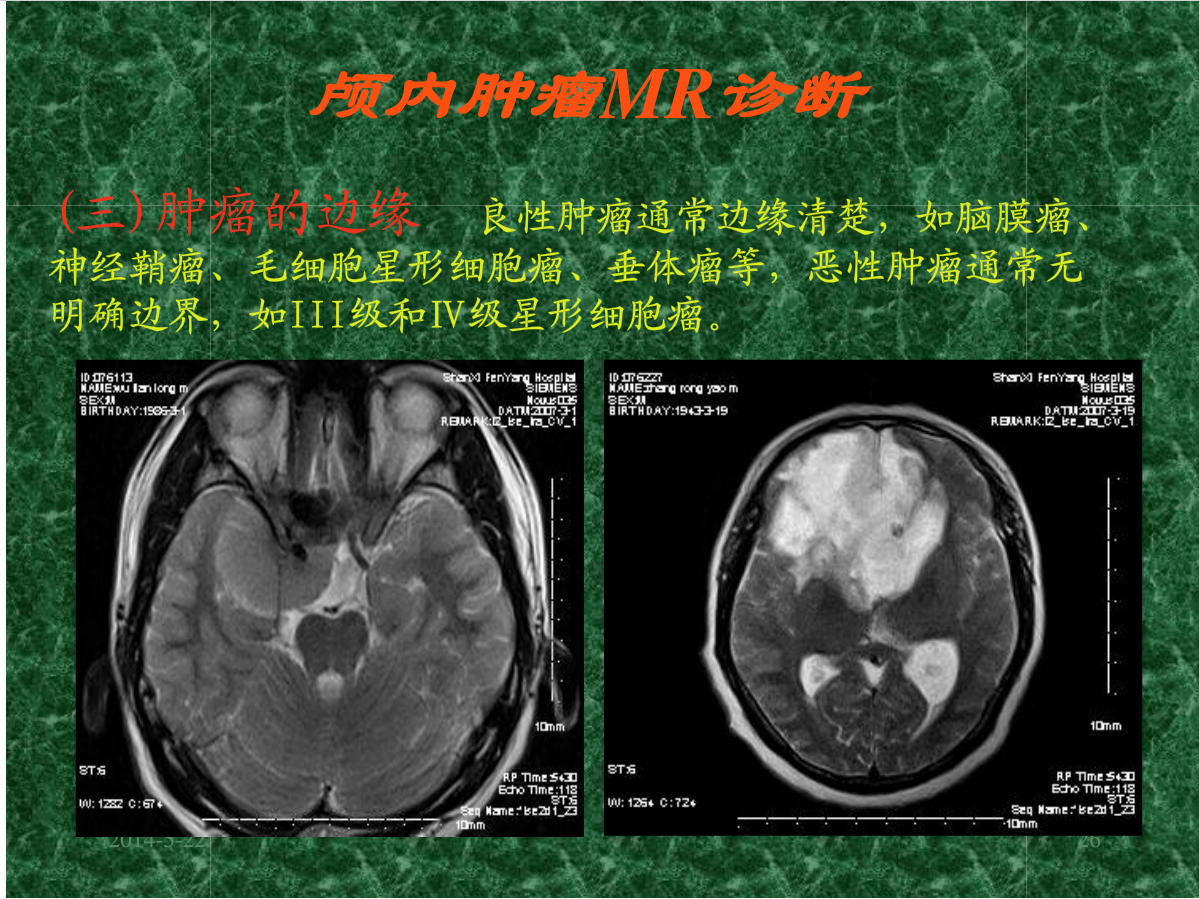 MRI成像在中枢神经系统的应用