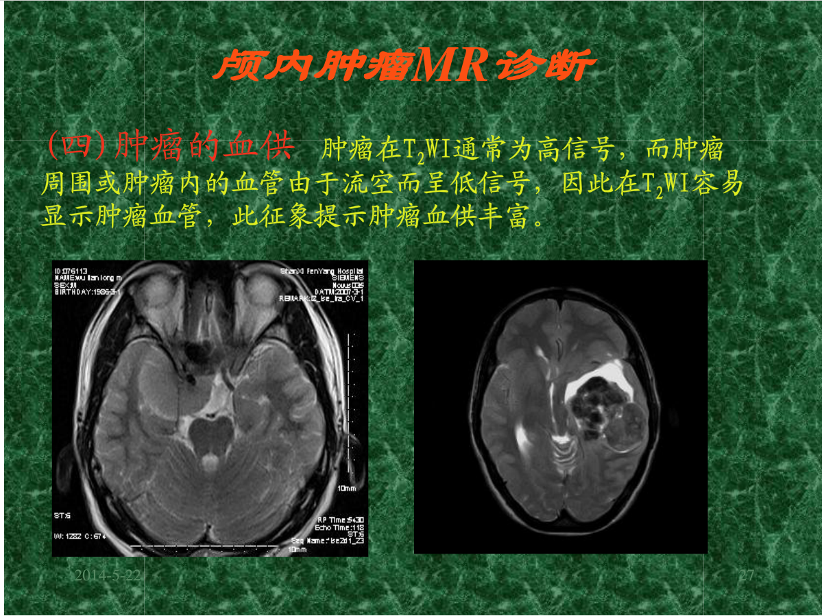 MRI成像在中枢神经系统的应用