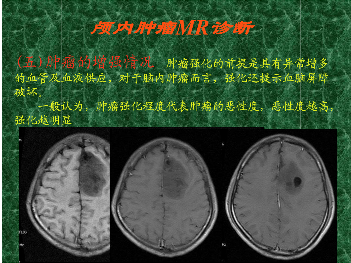 MRI成像在中枢神经系统的应用