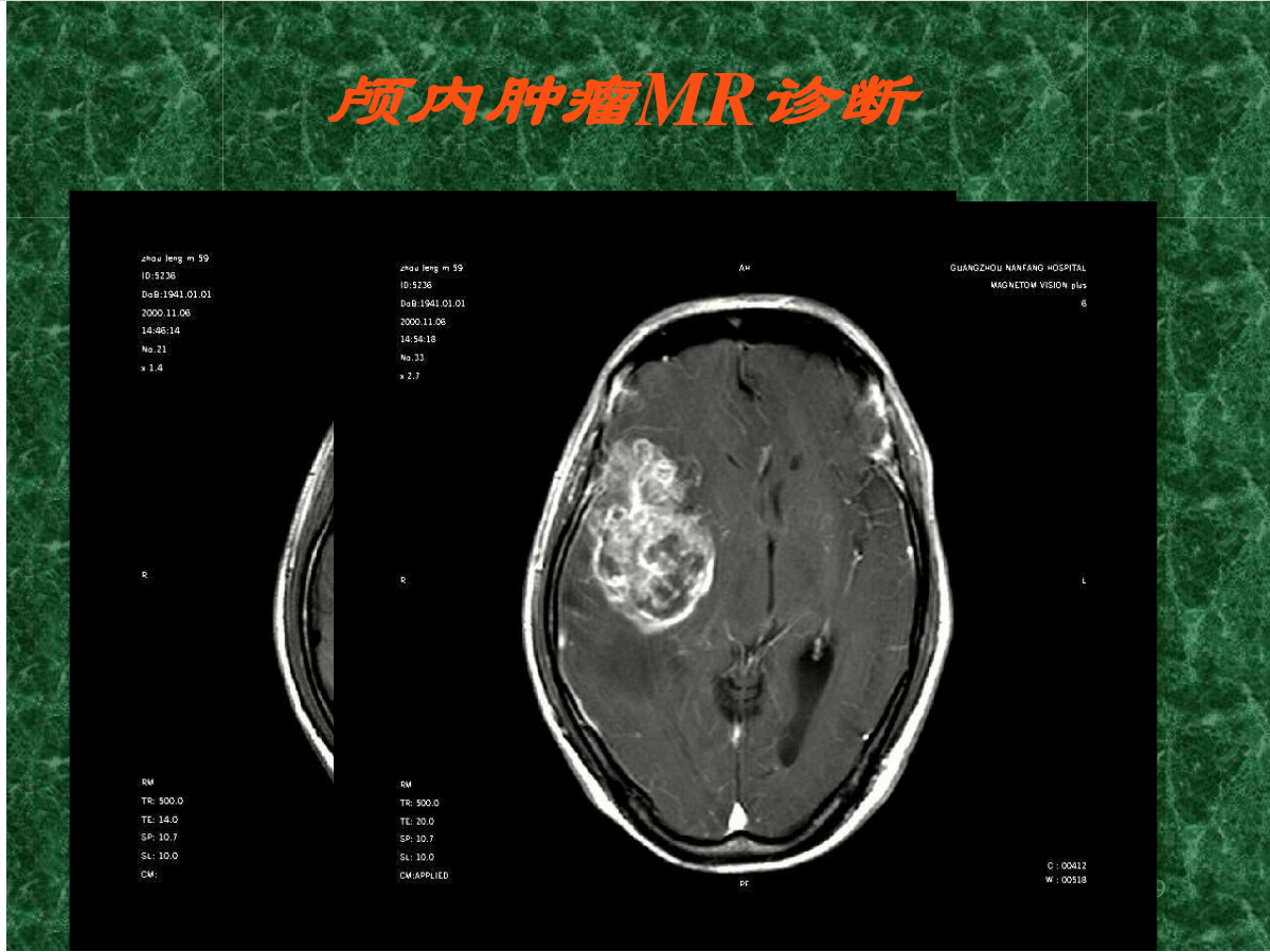 MRI成像在中枢神经系统的应用