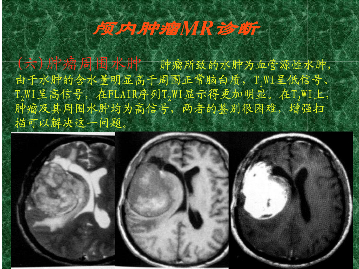 MRI成像在中枢神经系统的应用