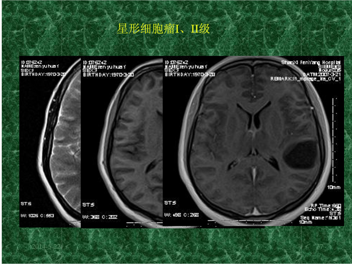MRI成像在中枢神经系统的应用
