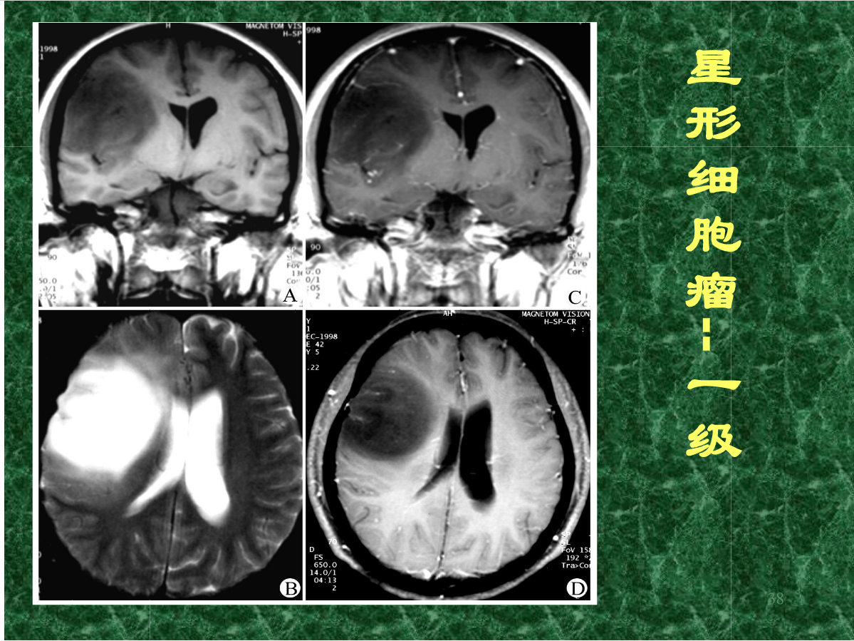 MRI成像在中枢神经系统的应用