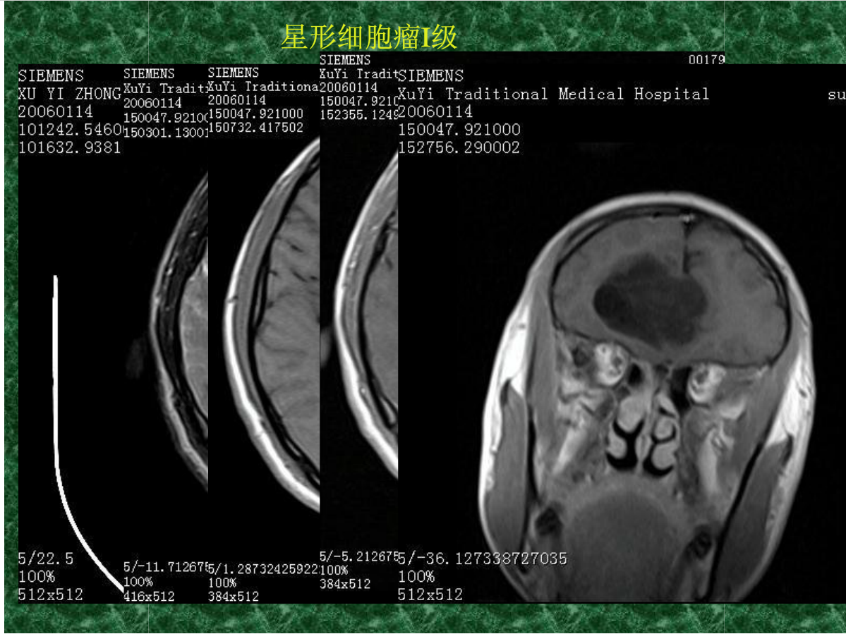 MRI成像在中枢神经系统的应用