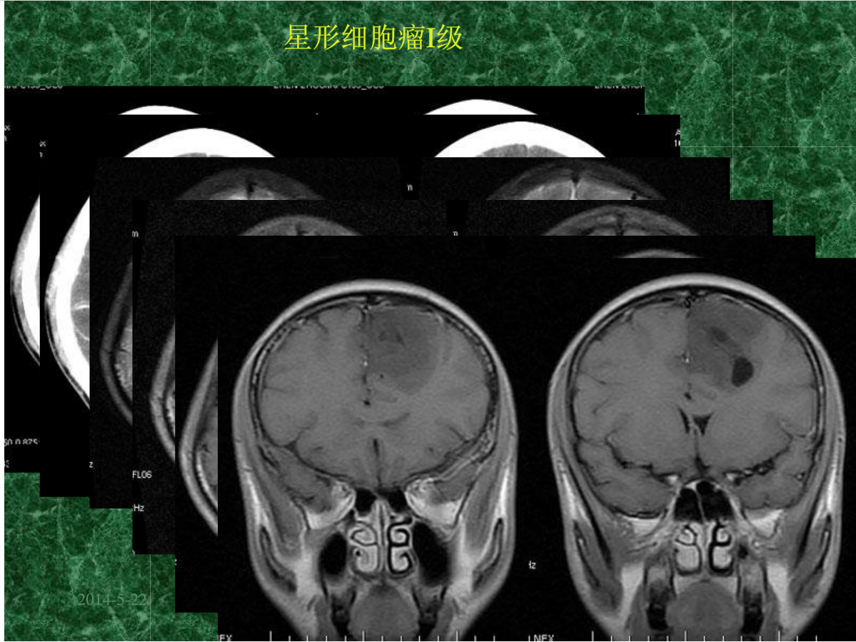 MRI成像在中枢神经系统的应用