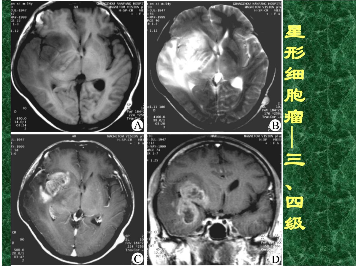 MRI成像在中枢神经系统的应用