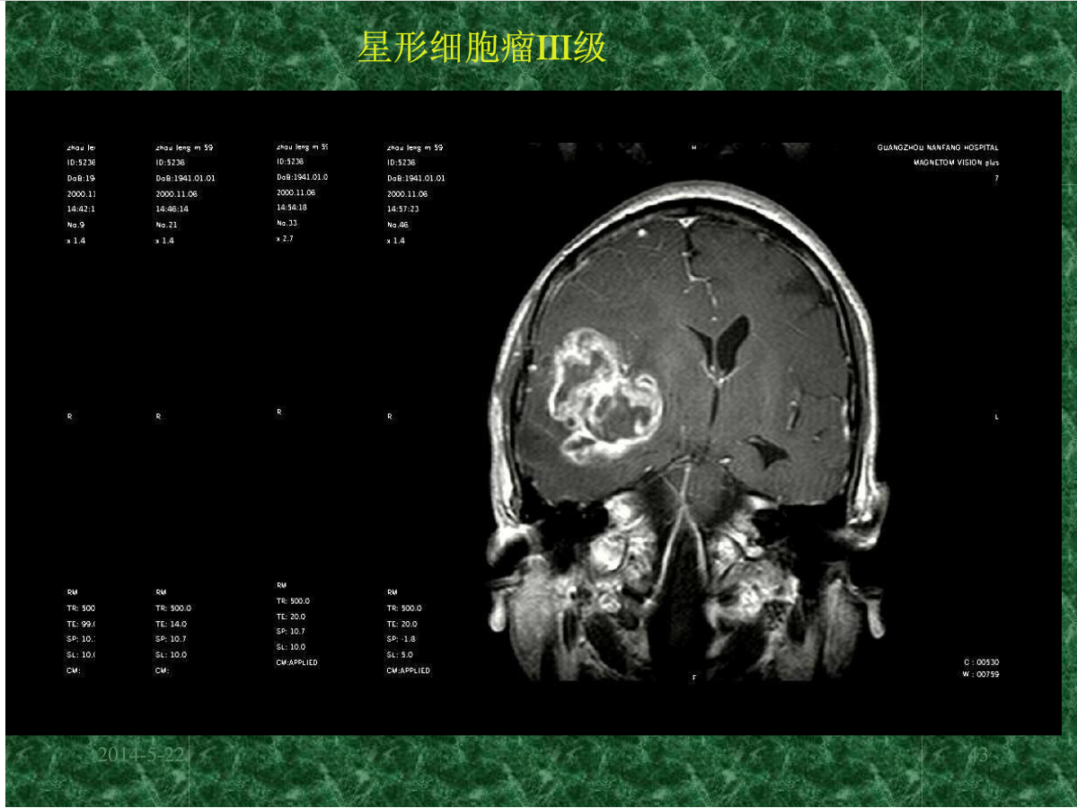 MRI成像在中枢神经系统的应用