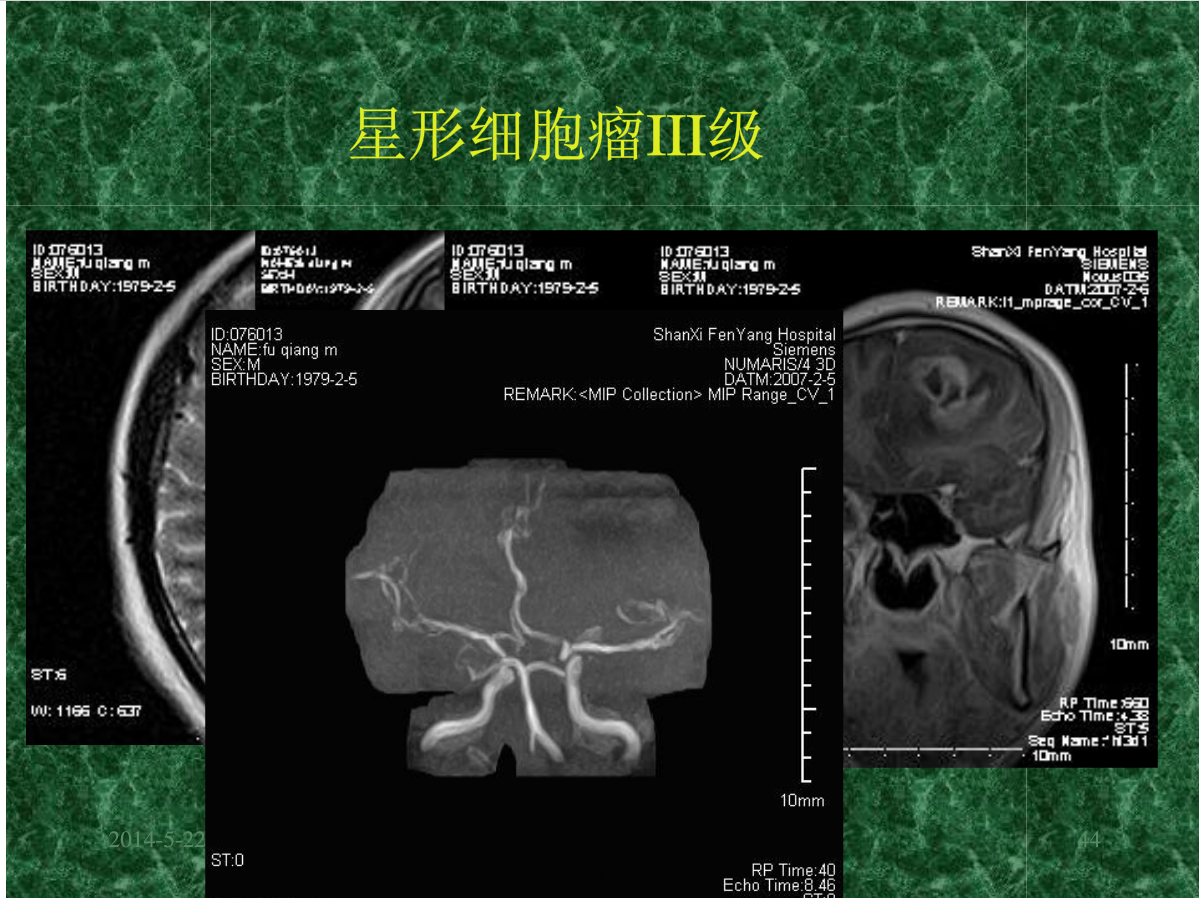 MRI成像在中枢神经系统的应用