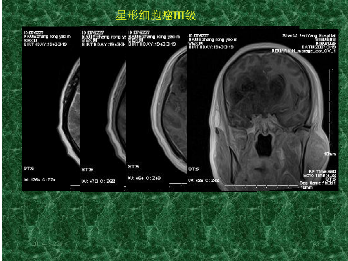 MRI成像在中枢神经系统的应用
