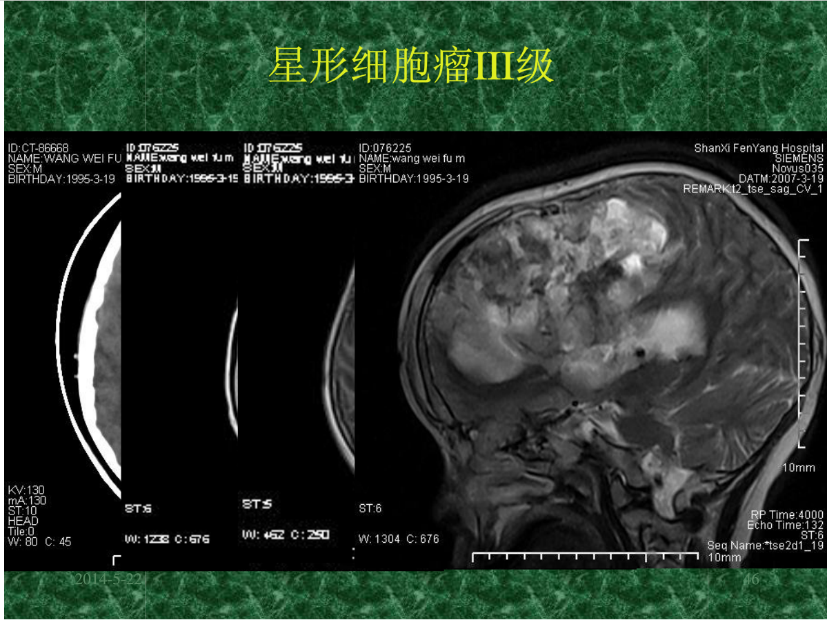 MRI成像在中枢神经系统的应用