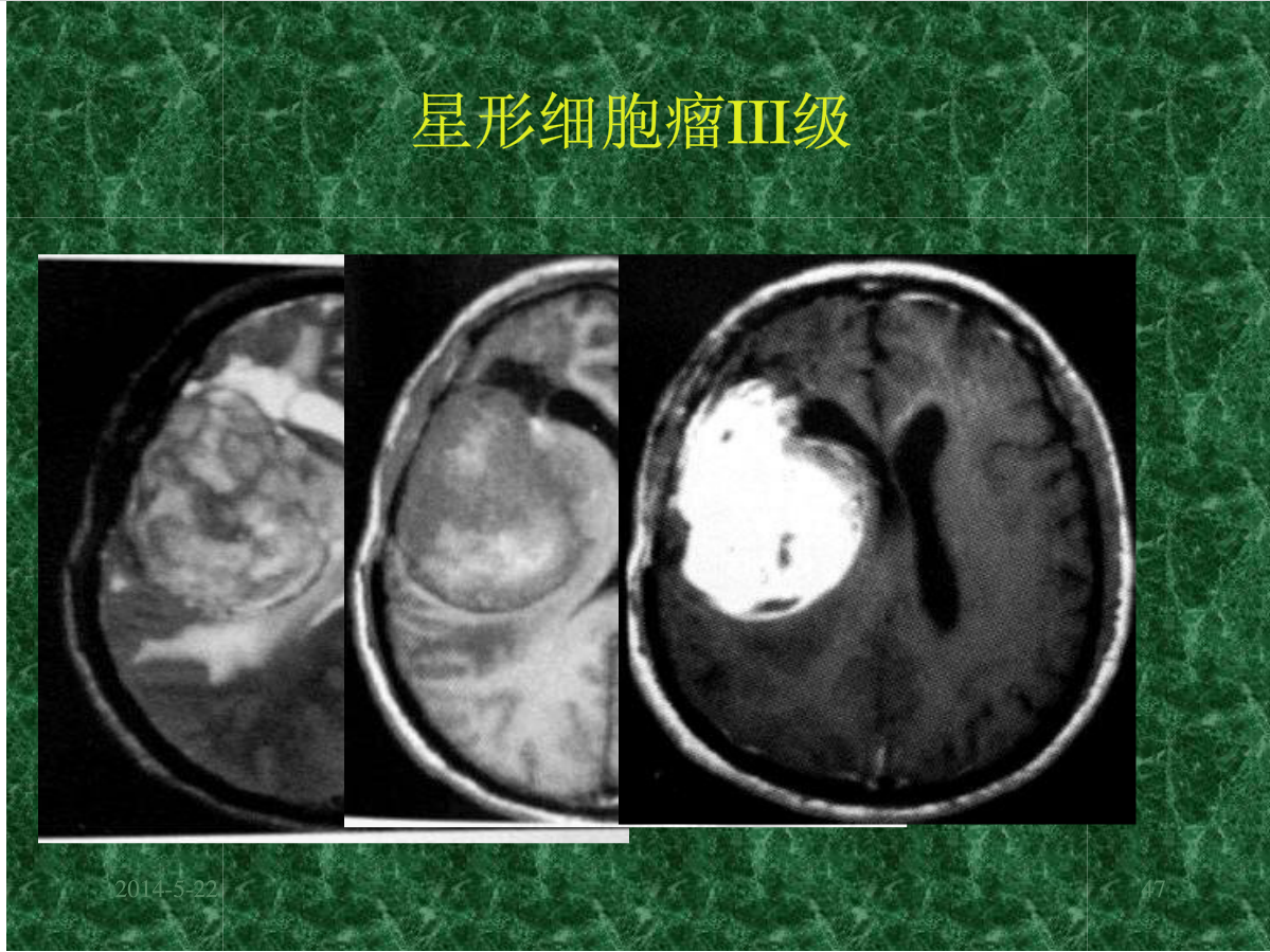 MRI成像在中枢神经系统的应用