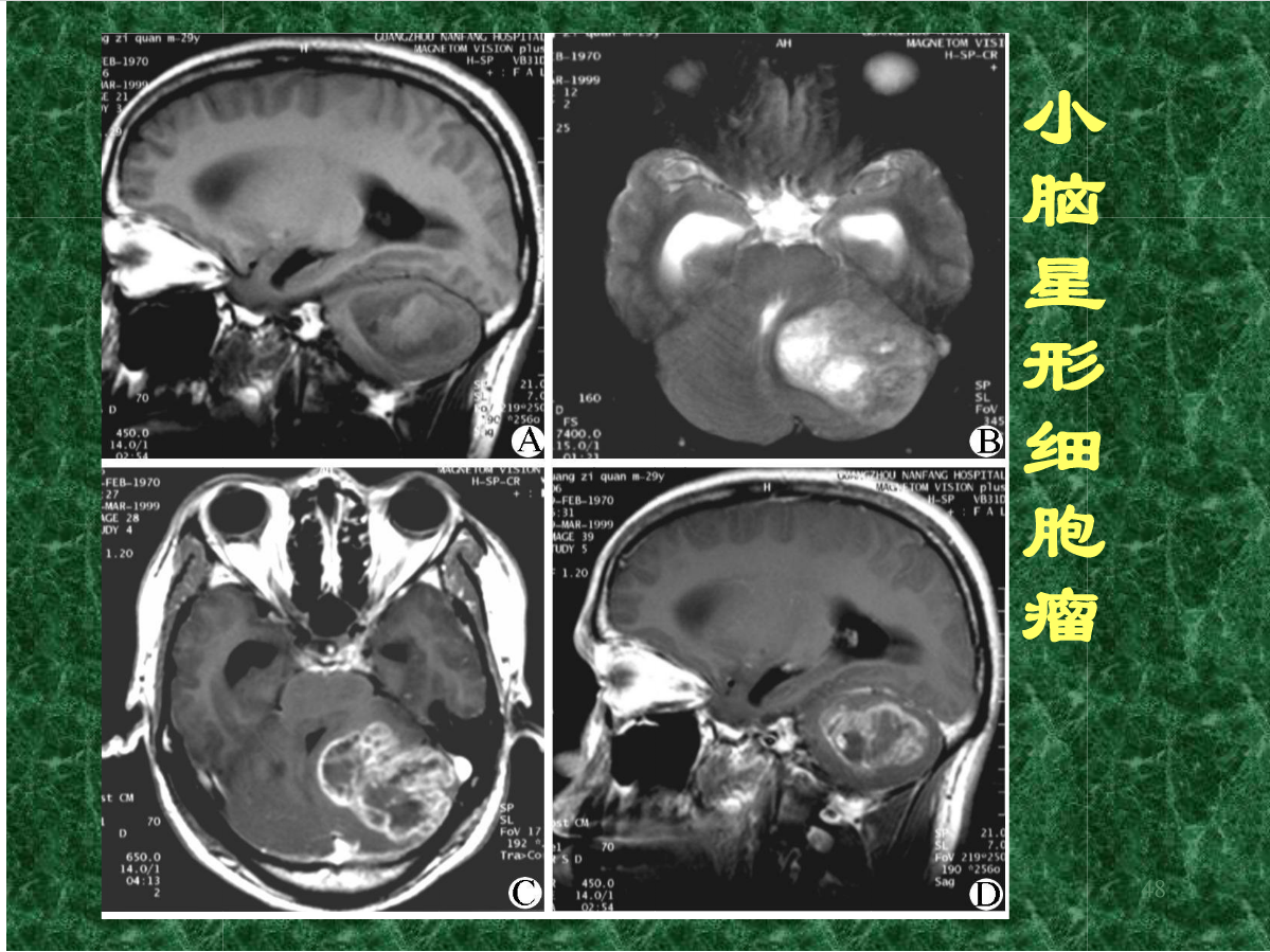 MRI成像在中枢神经系统的应用