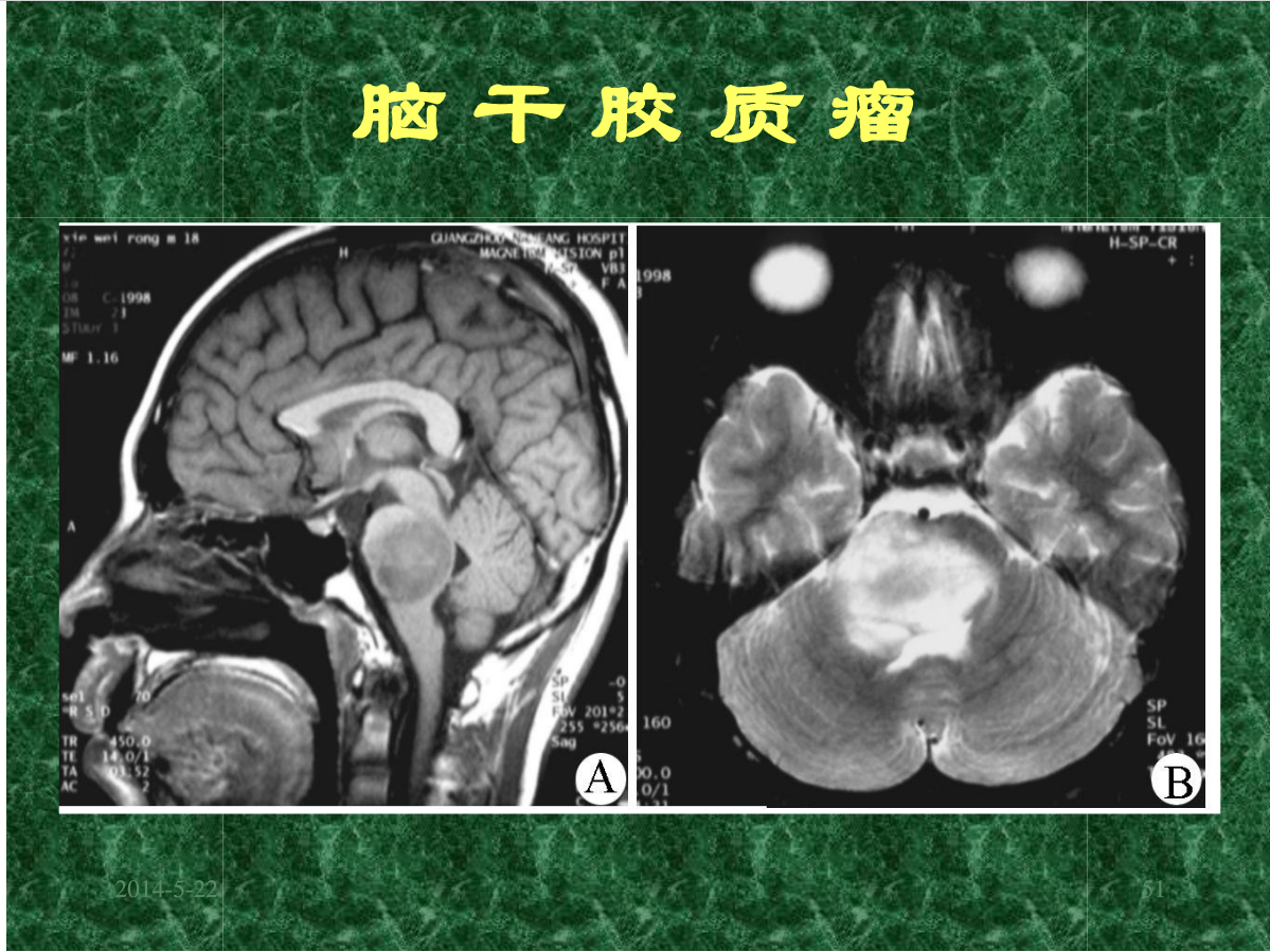 MRI成像在中枢神经系统的应用