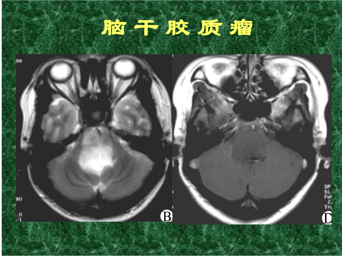 MRI成像在中枢神经系统的应用