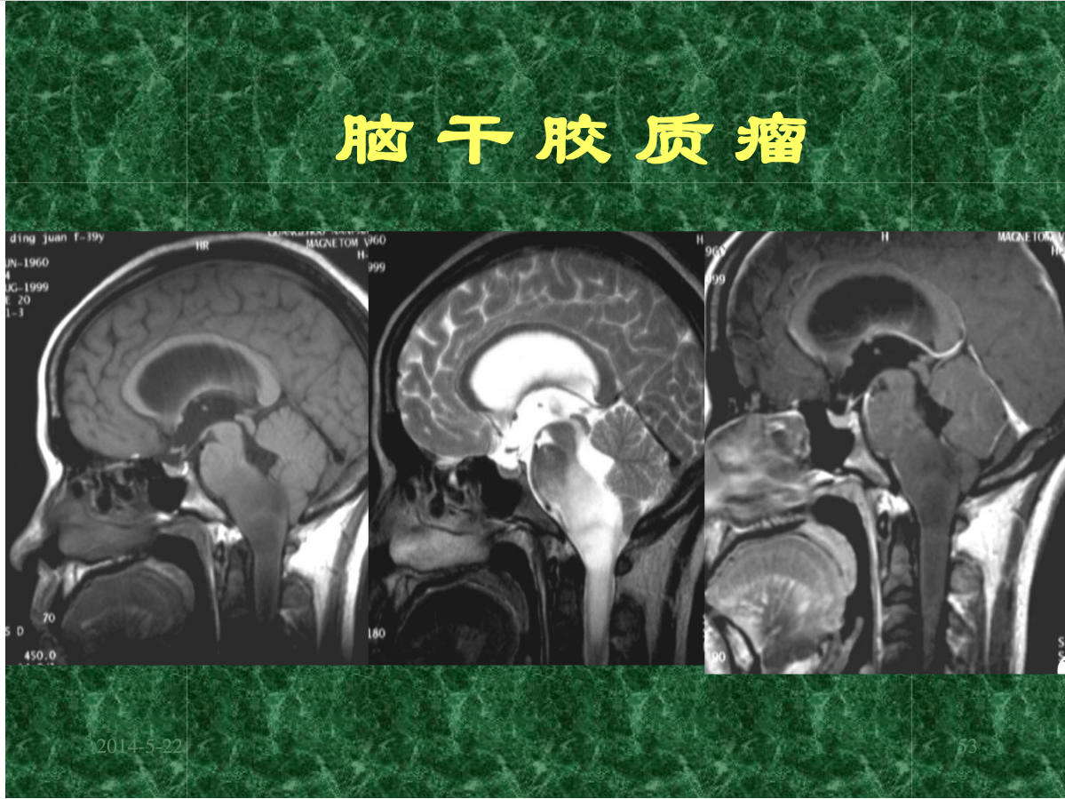 MRI成像在中枢神经系统的应用